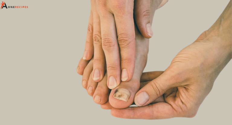 Natural Remedies for Treating Toenail Fungus