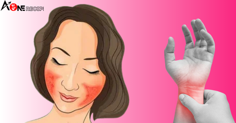8 Signs of Reversible Lupus